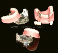 Implant Presentation Kit