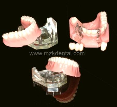 Implant Presentation Kit